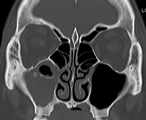 耳鼻科用ct さいたま市西区の耳鼻咽喉科おくクリニック