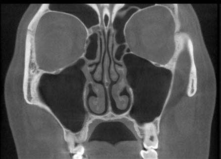 耳鼻科用ct さいたま市西区の耳鼻咽喉科おくクリニック