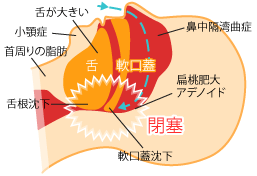 睡眠時無呼吸症候群について